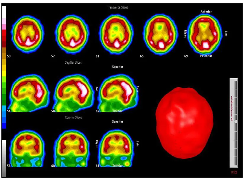 Chiropractic Sacramento CA Cerebral Perfusion in Healthy SS