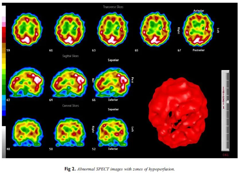 Chiropractic Sacramento CA Cerebral Perfusion in NP PTS